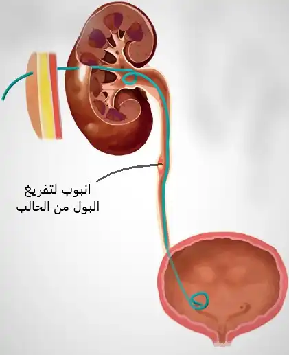 أنبوب فغر الكلية لتصريف البول مباشرةً من الكلية دون الحاجة لمروره إلى المثانة