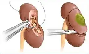 Robotic Tumor Removal