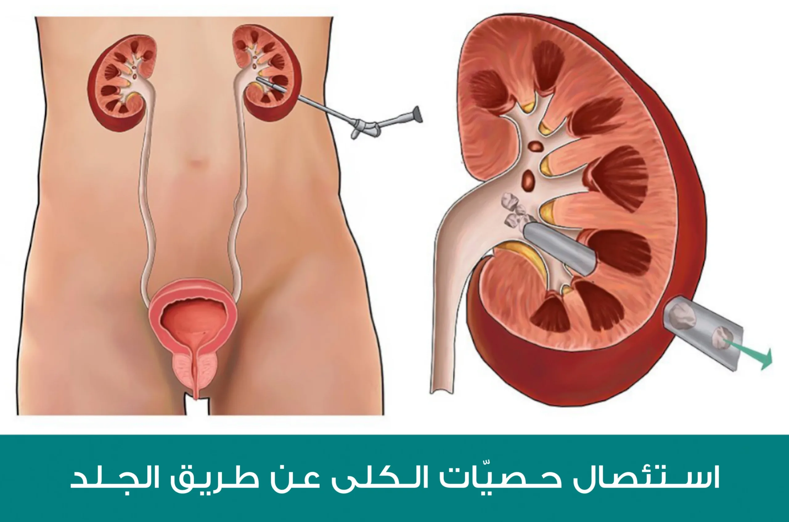 استئصال حصيات الكلى عن طريق الدخول مباشرةً إلى الكلى من خلال الجلد