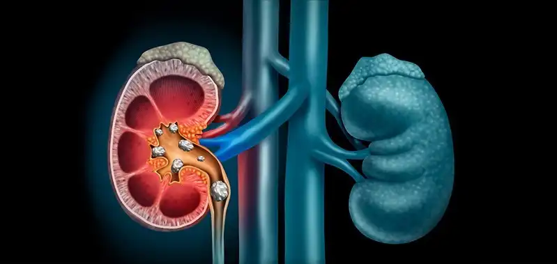 Intrarenal Stones