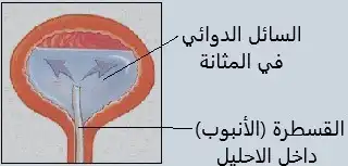 القسطرة داخل الاحليل والتي تسمح بإدخال أدوية للمثانة بشكل مباشر