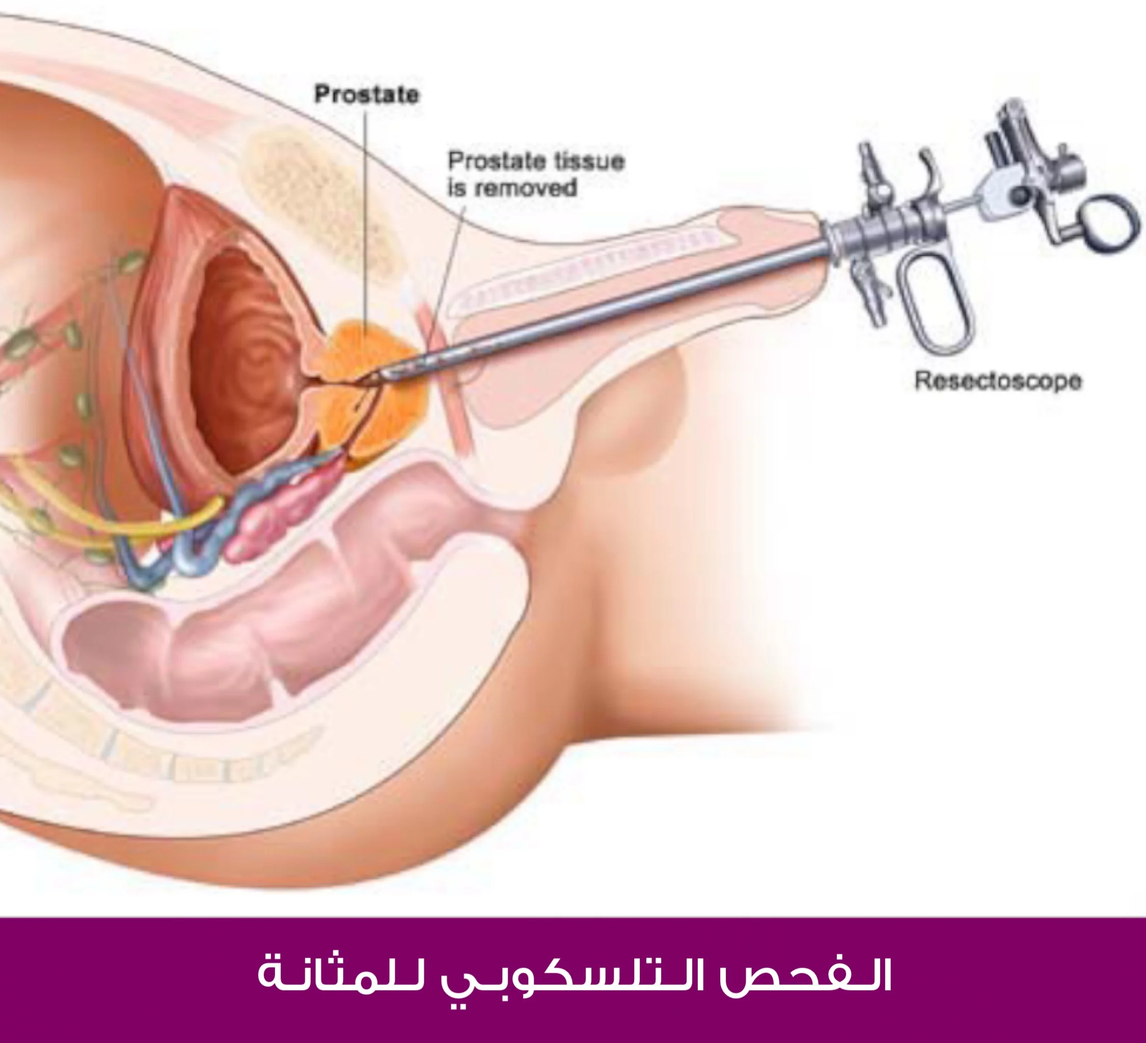 الفحص التلسكوبي للمثانة