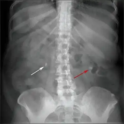 Diagnosing Kidney Stones On A Simple Abdominal X-Ray