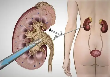 Percutaneous Kidney Stone Lithotripsy (Pcnl)