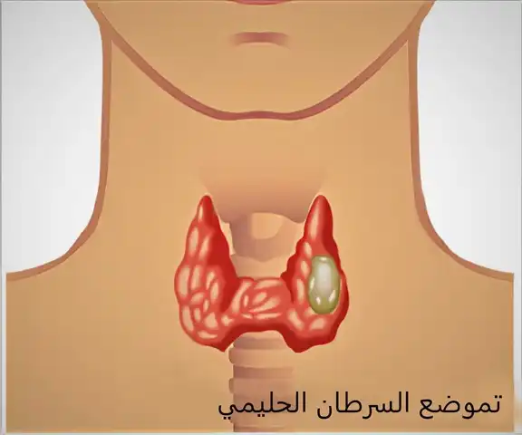 تموضع السرطان الحليمي بالغدة الدرقية