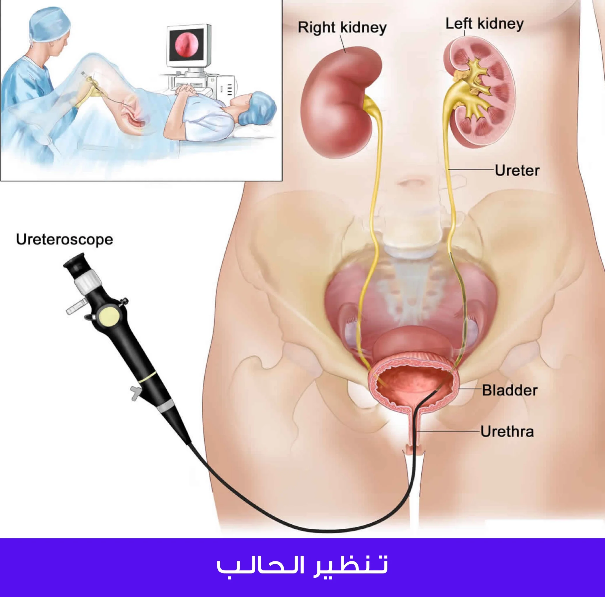 تنظير الحالب باستخدام المنظار المرن وذلك لنفي وجود مشاكل مرضية بالحالب