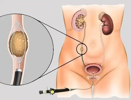 Ureteroscopy Is A Minimally Invasive Procedure In Which A Small Camera Is Inserted Into The Ureter And Lithotripsy Techniques Such As Lasers And Others Can Be Used To Break Up The Stones