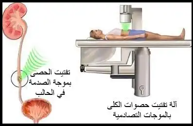 جهاز تفتيت حصوات الكلية بالموجات التصادمية