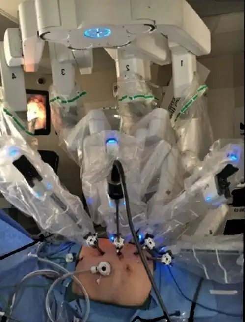 Image Showing The Positioning Of Devices During Robotic Surgery For Kidney Cancer In Turkey