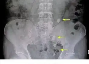 Image Showing Stones In Multiple Places In The Urinary Tract