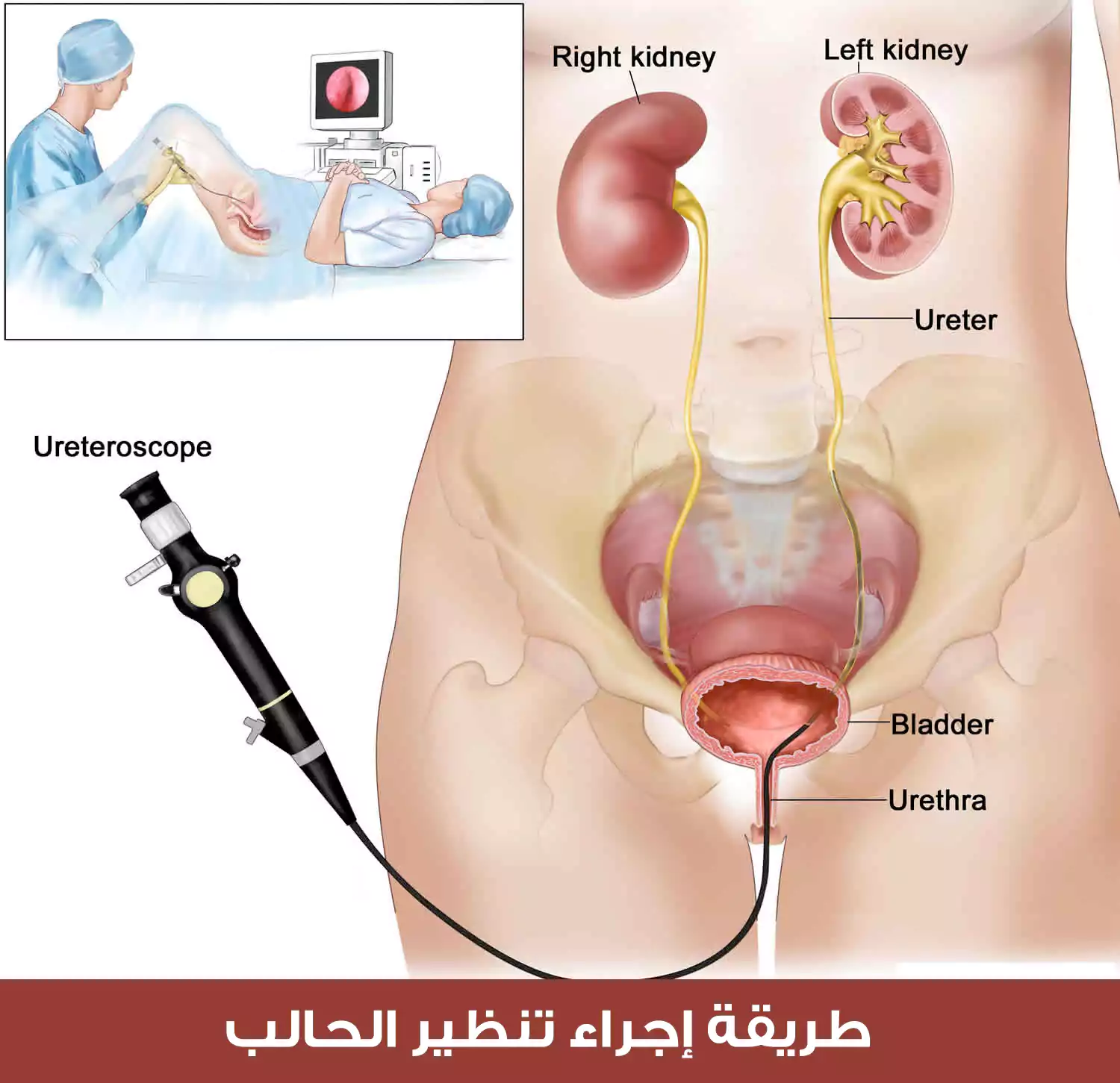 كيفية اجراء تنظير الحالب عبر إدخال المنظار خلال الإحليل