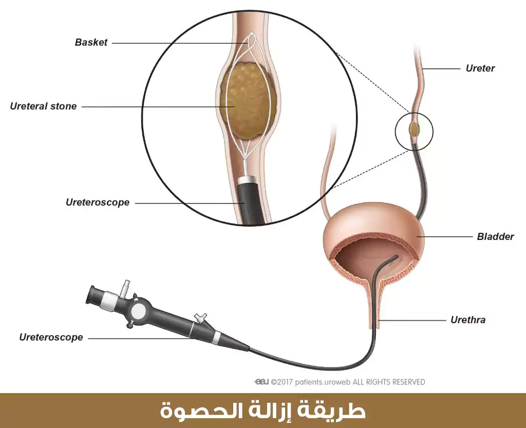 طريقة إزالة الحصوة باستخدام تنظير الحالب في تركيا