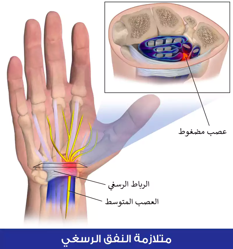 تحصل متلازمة النفق الرسغي نتيجة انضغاط العصب المتوسط في منطقة النفق الرسغي