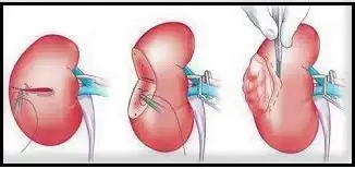 Stages Of Robotic Partial Nephrectomy