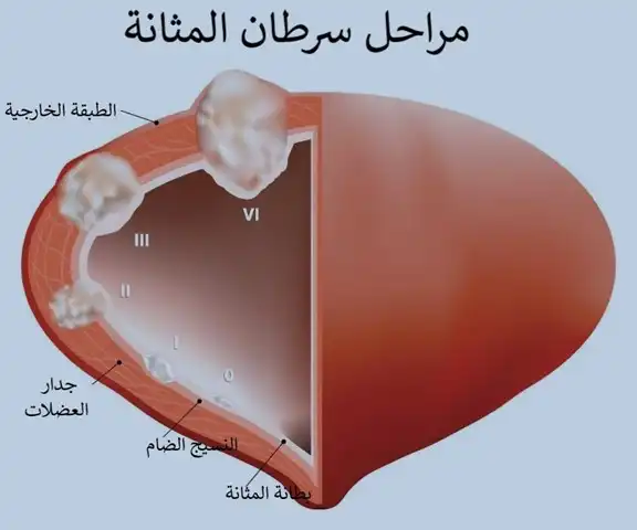 مراحل سرطان المثانة وفقاً لامتداد الخلايا الورمية