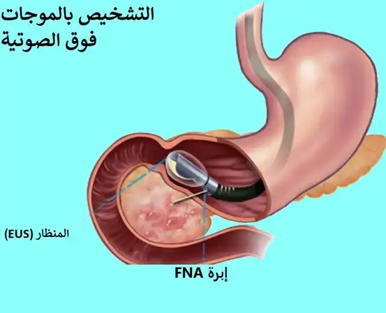 صورة توضح كيفية تشخيص سرطان البنكرياس بالموجات فوق الصوتية