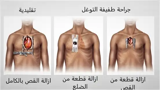 صورة تبين الاختلاف في الشقوق الجراحية بين الجراحة التقليدية وطفيفة التوغل للمجازة التاجية