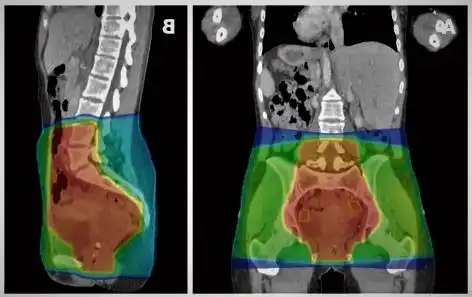 صورة توضح مكان توجيه العلاج الإشعاعي الباكر للحوض لعلاج السرطانات في هذه المنطقة