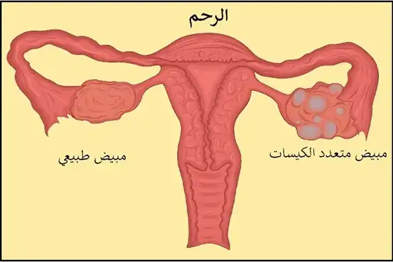 صورة للجهاز التناسلي الأنثوي وما يبدو عليه المبيض في حالة تشكل عدة كسيات فيه