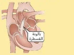 صورة تبين بالون القسطرة لتوسيع التضيقات الشرياني