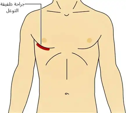 صورة توضح مكان الندبة وشكلها بعد جراحة مجازة الشريان التاجي طفيفة التوغل