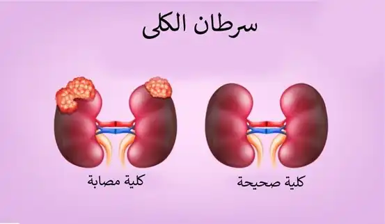 كلى سليمة وكلى مصابة بسرطان الكلى