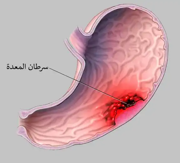 سرطان المعدة هو عبارة عن تكاثر غير مضبوط لخلايا بطانة المعدة قد يؤدي إلى نزف