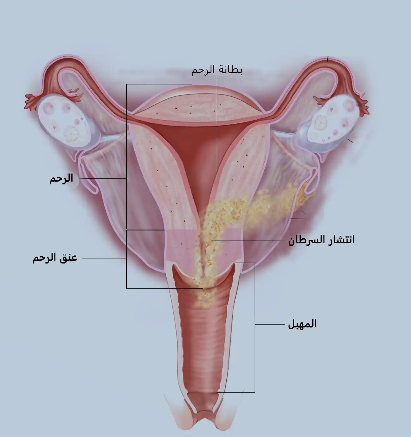 سرطان الرحم