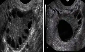 صورة بالأشعة الينية البسيطة تظهر المبيض متعدد الكيسات