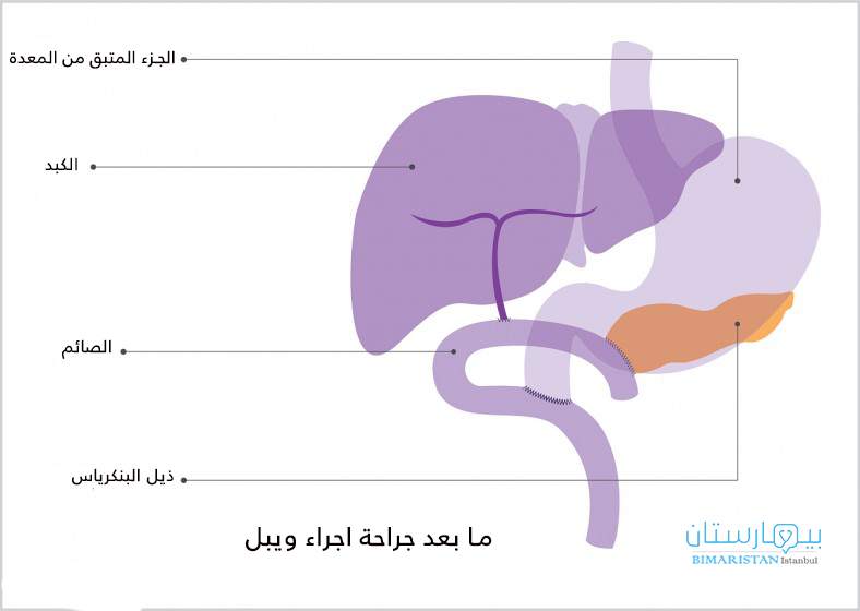 بعد استئصال رأس البنكرياس في اجراء ويبل يعيد الجراح وصل الأعضاء المتبقية