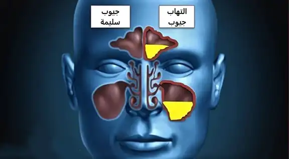 يتميز التهاب الجيوب الأنفية الشديد بتراكم شديد للقيح في الجيوب وأعراض حادة