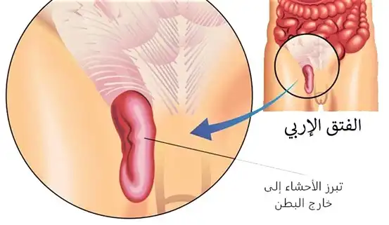 في الفتق الإربي عند الأطفال تنفتق وتبرز الأحشاء إلى خارج البطن