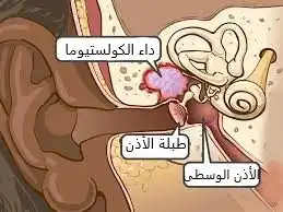 يقع الورم الكوليسترولي بين الأذن الوسطى والطبلة والخشاء