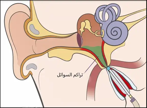 يستخدم بالون قناة استاكيوس من أجل تصريف السوائل المتراكمة بسبب انسداد قناة استاكيوس