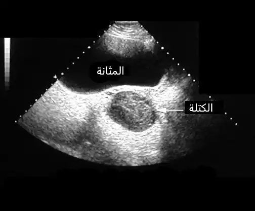 تم التأكد من تشخيص سرطان المبيض بصورة الإيكو