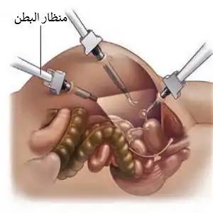 يعتبر تنظير البطن وسيلة طفيفة التوغل للكشف عن سرطان المبيض