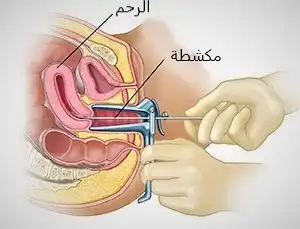 يتم توسيع وكحت الرحم باستعمال أداتين هما الموسع والمكشطة