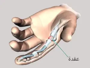 عقدة في الإصبع الزنادية