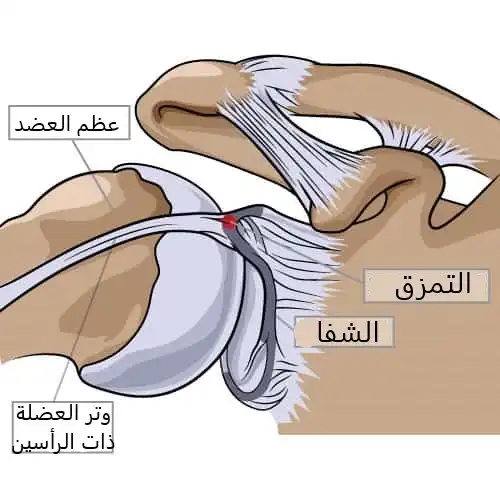 تمزق شفا الكتف 10 عندما يشمل تمزق شفا الكتف مكان ارتكاز وتر العضلة ذات الرأسيت يصبح استخدام العضلة مؤلماً