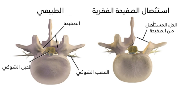 تجرى عملية استئصال الصفيحة الفقرية في تركيا من أجل تخفيف الضغط على الحبل الشوكي