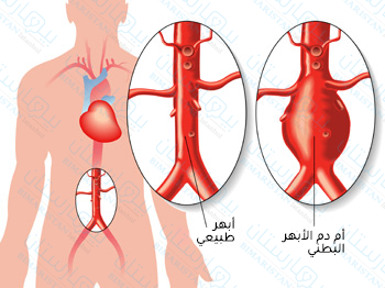 يضطرب جريان الدم عند حدوث أم دم الأبهر البطني بسبب التوسع المفاجئ في جدار الشريان