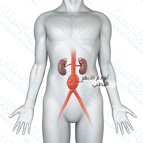 تتوضع أم دم الأبهر البطني في الجزء البطني من الشريان الأبهر