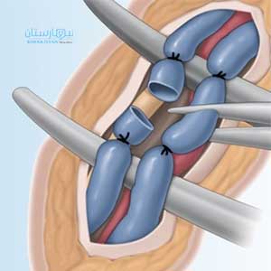 Varicocele Can Be Treated By Ligating The Spermatic Vein Under The Inguinal Ligament