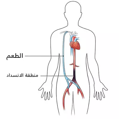 المجازة الفخذية الابطية عبارة عن طعم وعائي يصل بين الشريان الإبطي والشريان الفخذي لتجاوز منطقة الانسداد