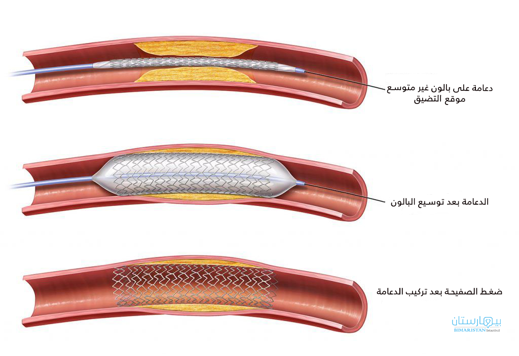 يتم إجراء قسطرة الشرايين الطرفية عن طريق إيصال الدعامة إلى الشريان المتضيق بواسطة القسطرة ثم يتم توسيعه بالبالون ثم تثبيته بالدعامة
