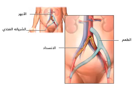 يتم في جراحة مجازة الشريان الأبهر زرع طعم يتجاوز منطقة الانسداد