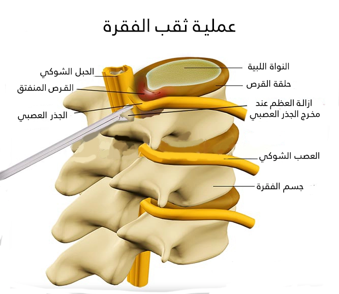 تجرى عملية ثقب الفقرة في تركيا لإزالة النتوئات والزوائد العظمية التي تضغط على الجذور العصبية