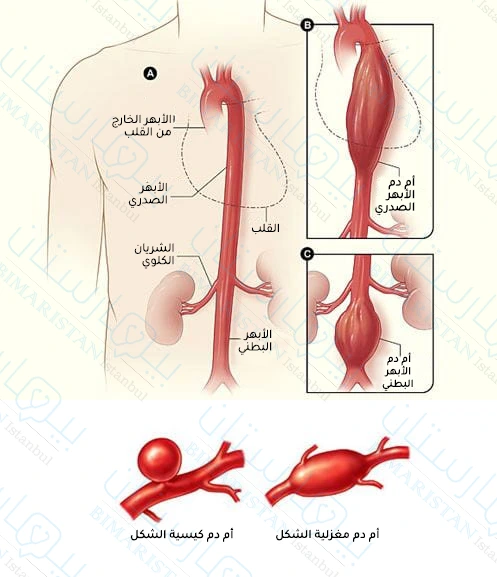 تقسم أمهات دم الأبهر البطني بحسب شكلها إلى أمهات دم مغزلية الشكل وأمهات دم كيسية الشكل