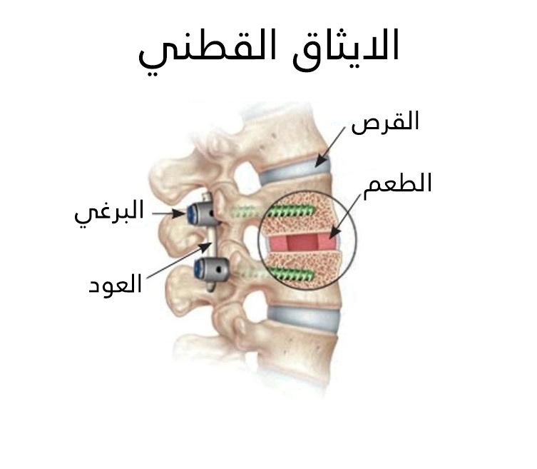 يتم دمج فقرتين متتاليتين بإزالة الصفيحة الفقرية وتركيب الأسلاك والبراغي واستبدال القرص الفقري المرن بطعم ثابت