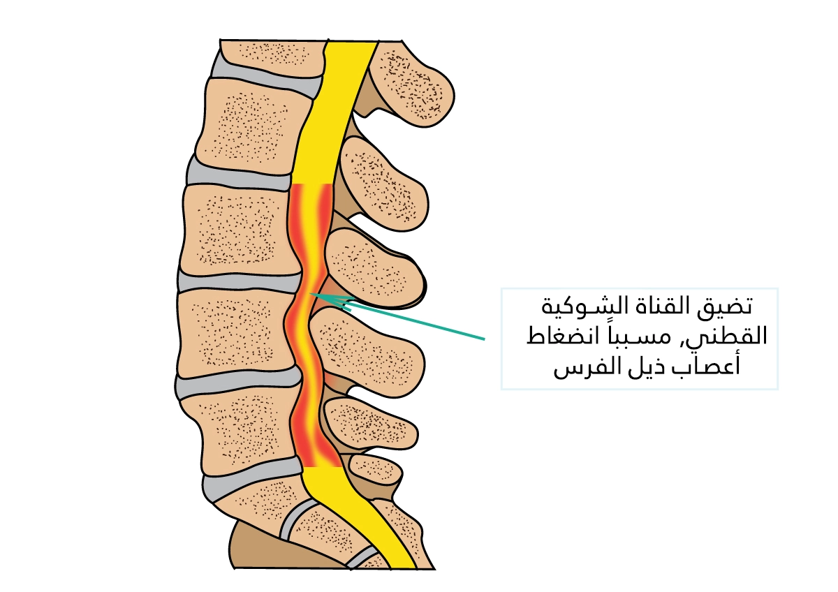 تضيق القناة الشوكية القطنية مسبباً انضغاط أعصاب ذيل الفرس